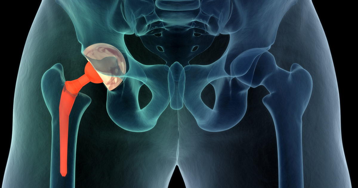 Things to Know About Joint Replacement